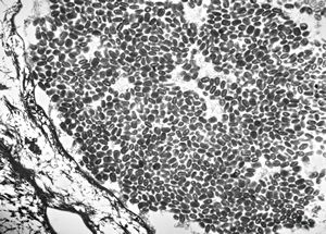 poxvirus - molluscum contagiosum